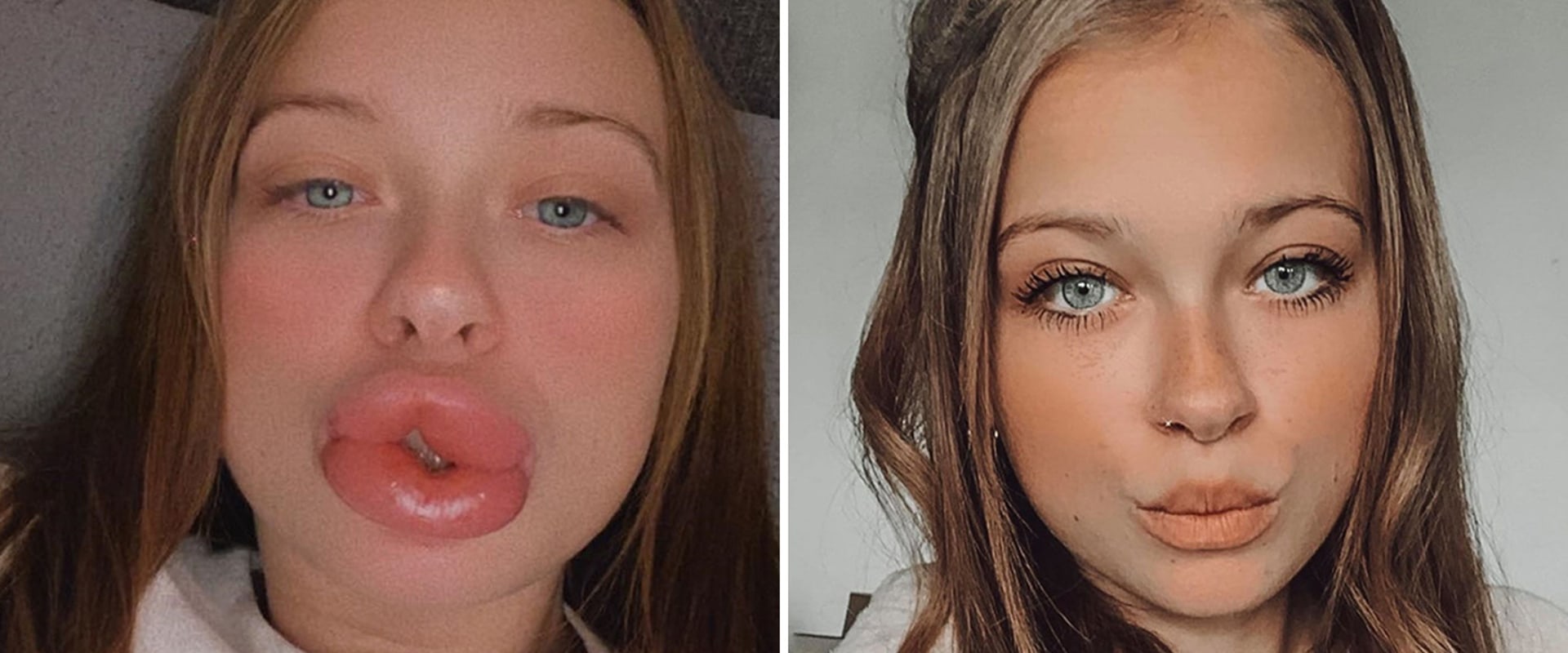 why-are-my-lip-injections-lumpy-a-guide-to-understanding-and